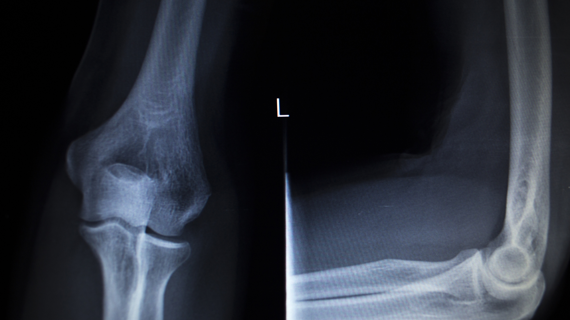 X-quang khớp khuỷu giúp phát hiện gãy xương và trật khớp