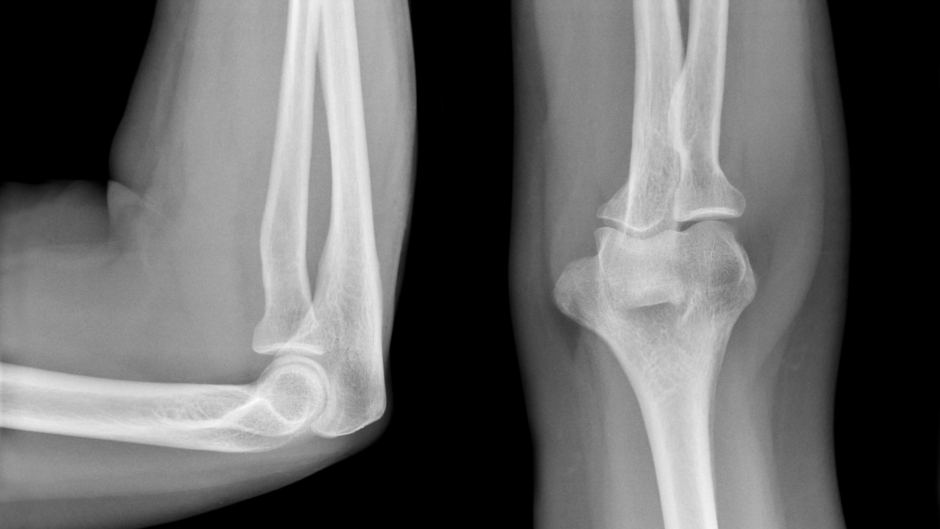 Nhận biết dấu hiệu bất thường trên X-quang khớp khuỷu