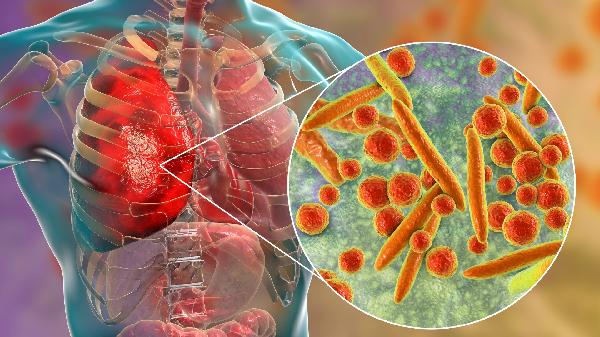 Xạ hình phổi không được thực hiện nếu bệnh nhân đang bị viêm phổi giai đoạn cấp