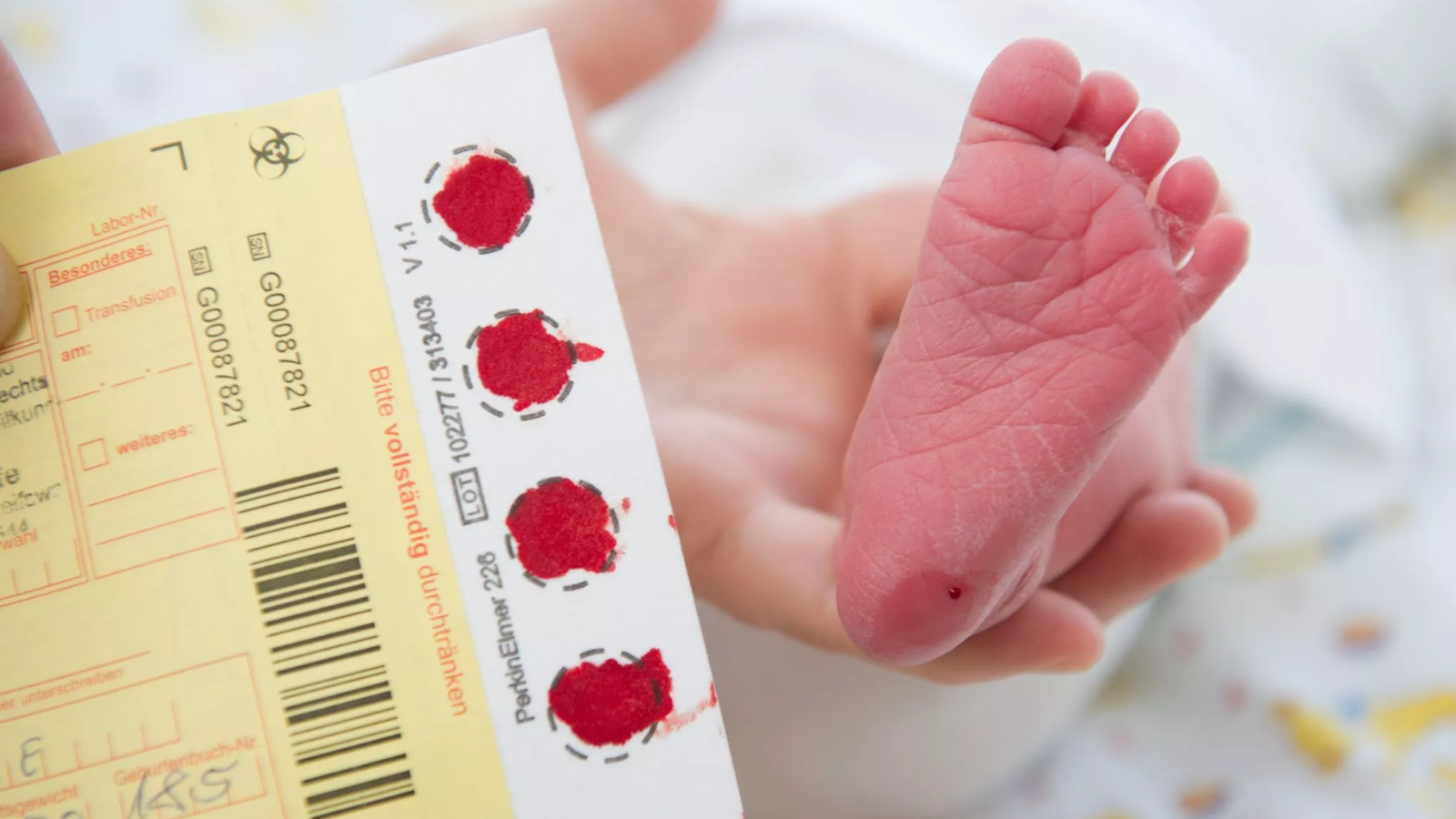 Xét nghiệm 17 OH Progesterone là gì? 3
