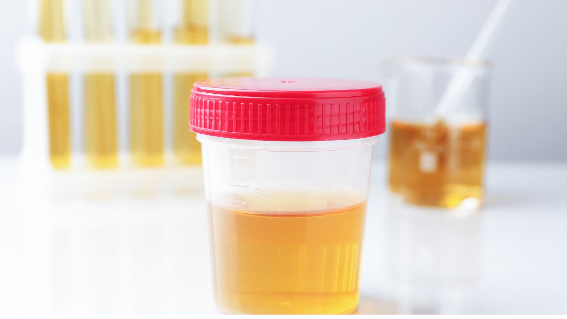 Nước tiểu là mẫu bệnh phẩm để thực hiện xét nghiệm Microalbumin