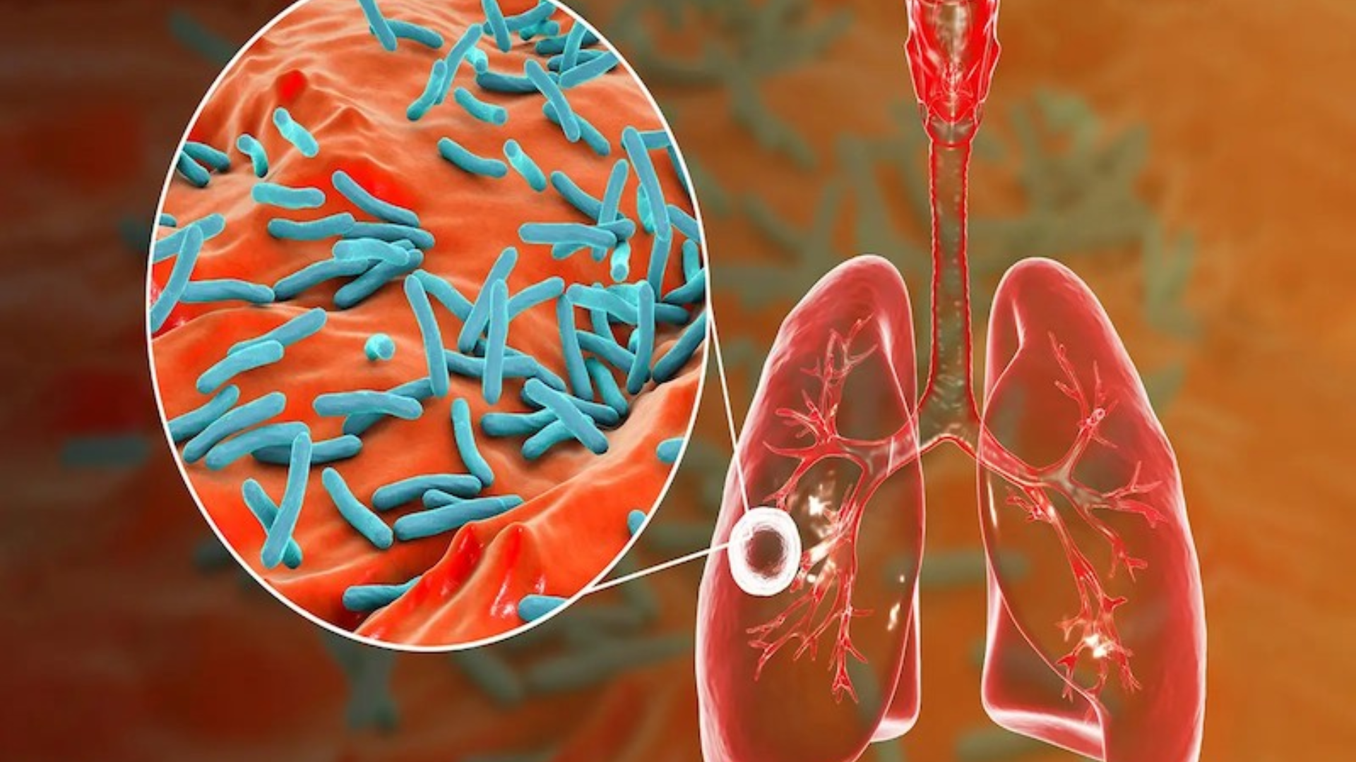 Xét nghiệm Adenosine Deaminase không thể thay thế các xét nghiệm xác định vi khuẩn lao trong phác đồ chẩn đoán toàn diện