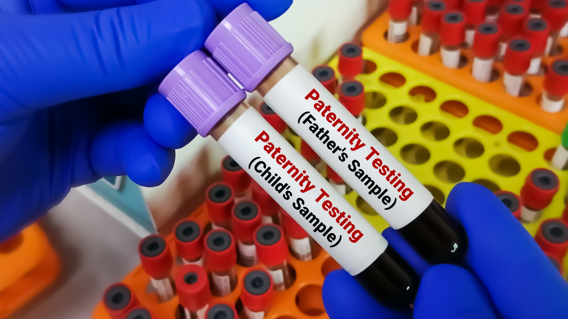 Mẫu máu thường được sử dụng trong các xét nghiệm y khoa, đặc biệt khi cần phân tích sâu hơn về gen hoặc kết hợp với các chỉ số sinh hóa khác