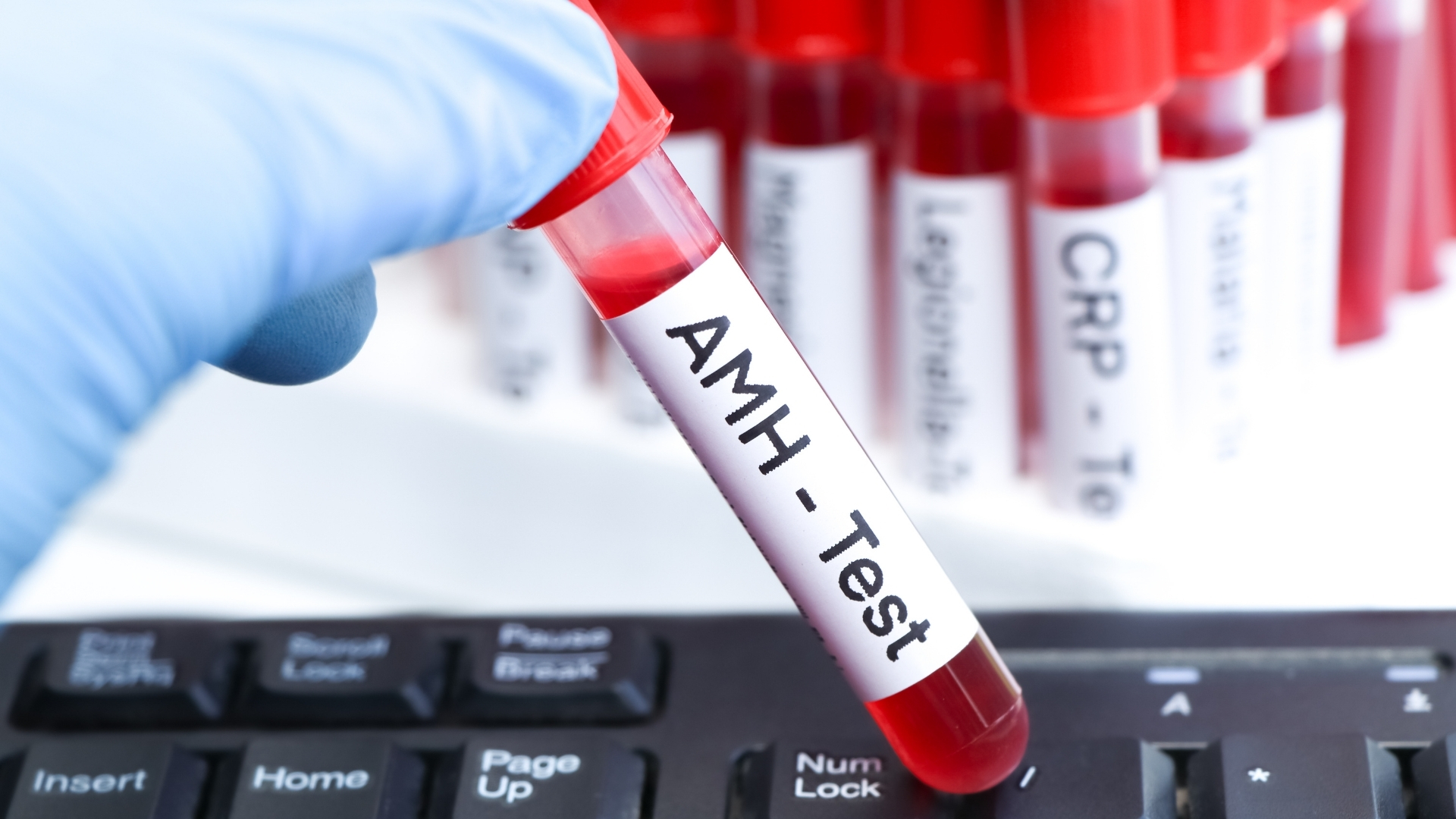 Xét nghiệm AMH bao lâu có kết quả? Thời gian trả kết quả của xét nghiệm này thường dao động từ 24 - 72 giờ kể từ khi lấy mẫu máu