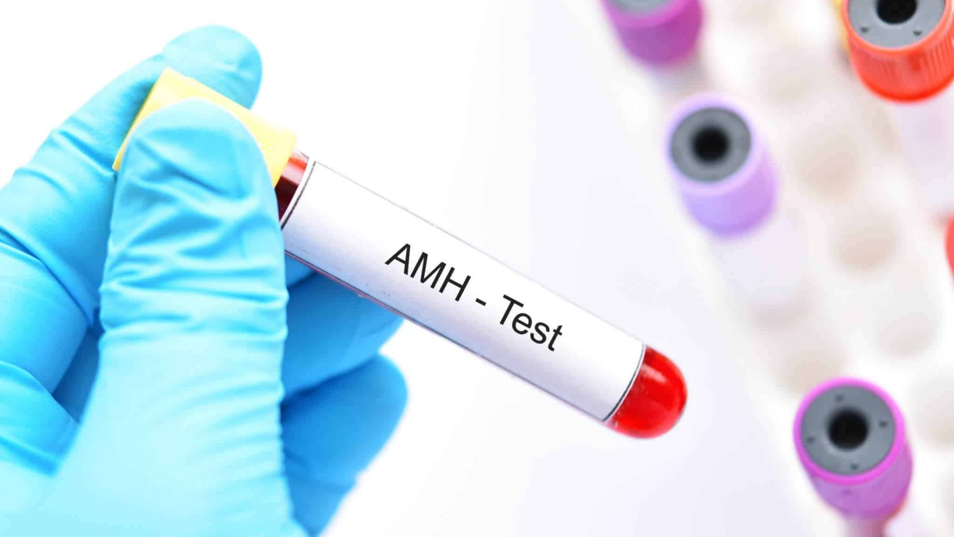 Nồng độ AMH phản ánh dự trữ buồng trứng