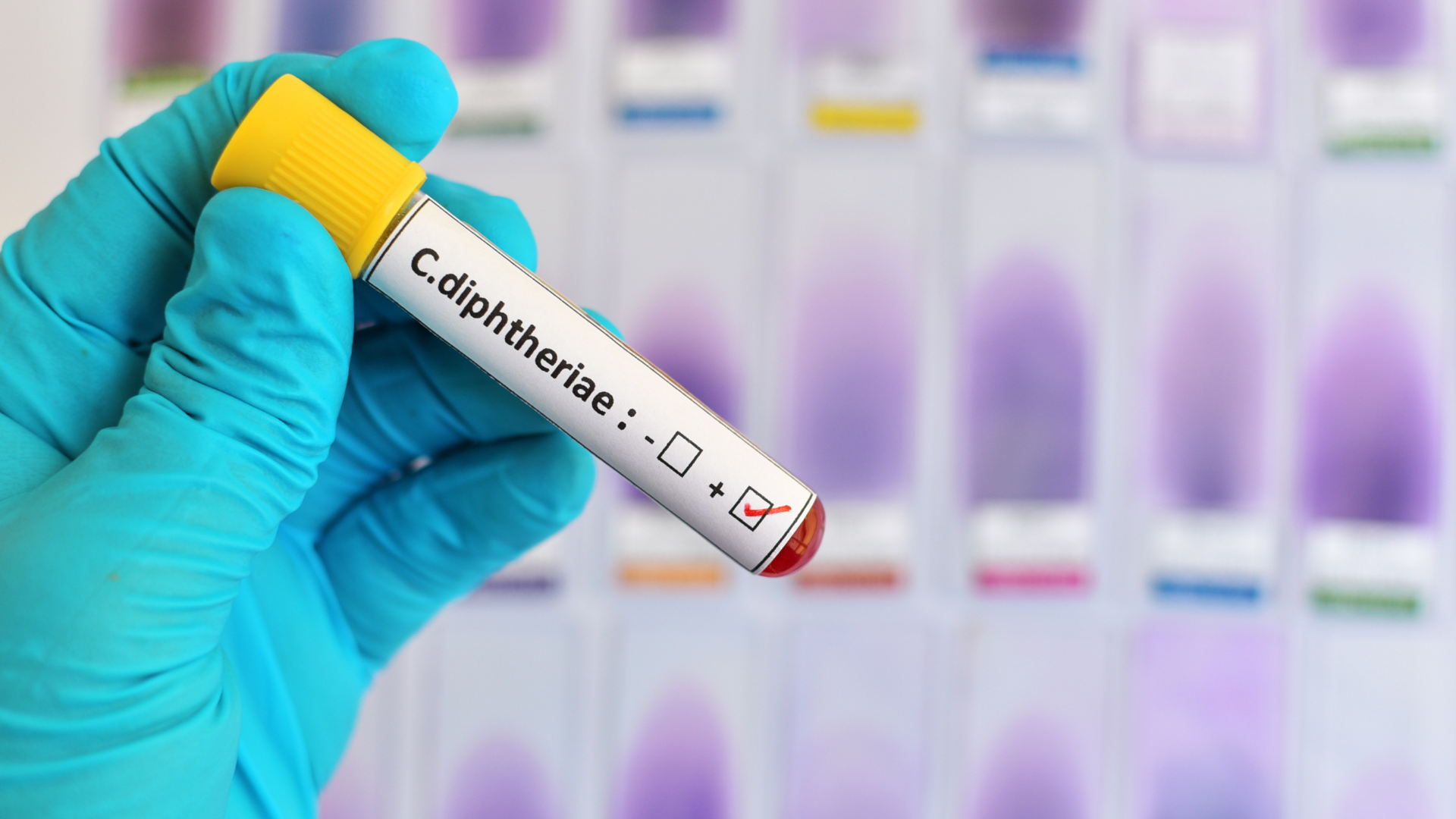 Xét nghiệm bạch hầu giúp phát hiện bệnh sớm