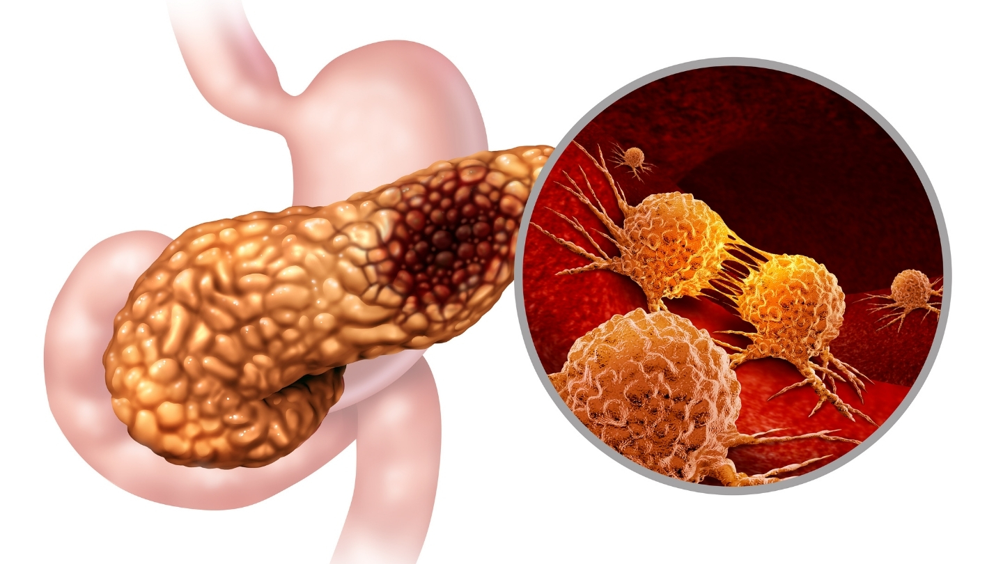 Việc đọc và diễn giải chỉ số CA 19-9 theo các giai đoạn ung thư tụy giúp hỗ trợ đánh giá mức độ tiến triển bệnh và tiên lượng