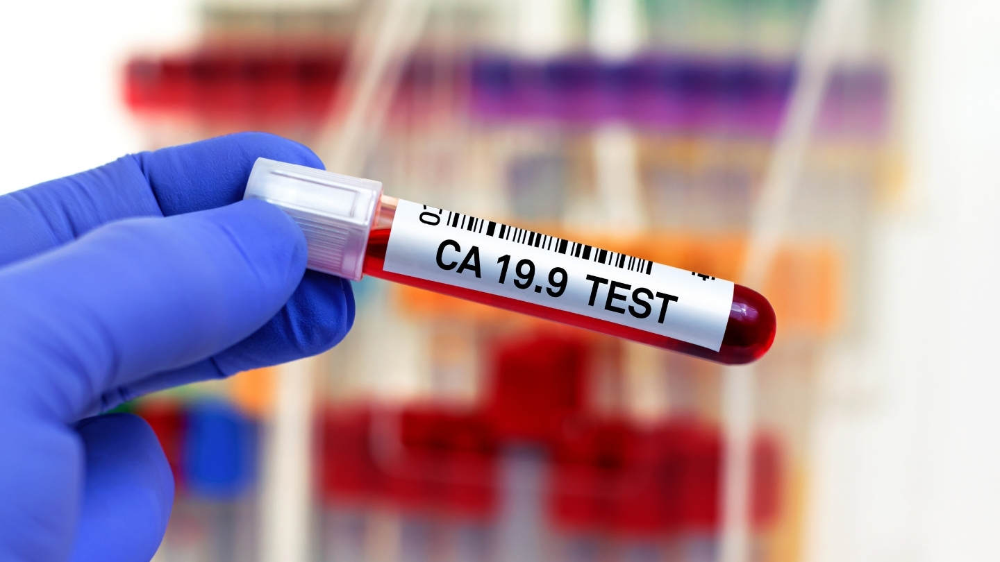 Nhiều bệnh lý không phải ung thư như viêm tụy, tắc mật, xơ gan hay viêm gan cũng có thể làm tăng CA 19-9