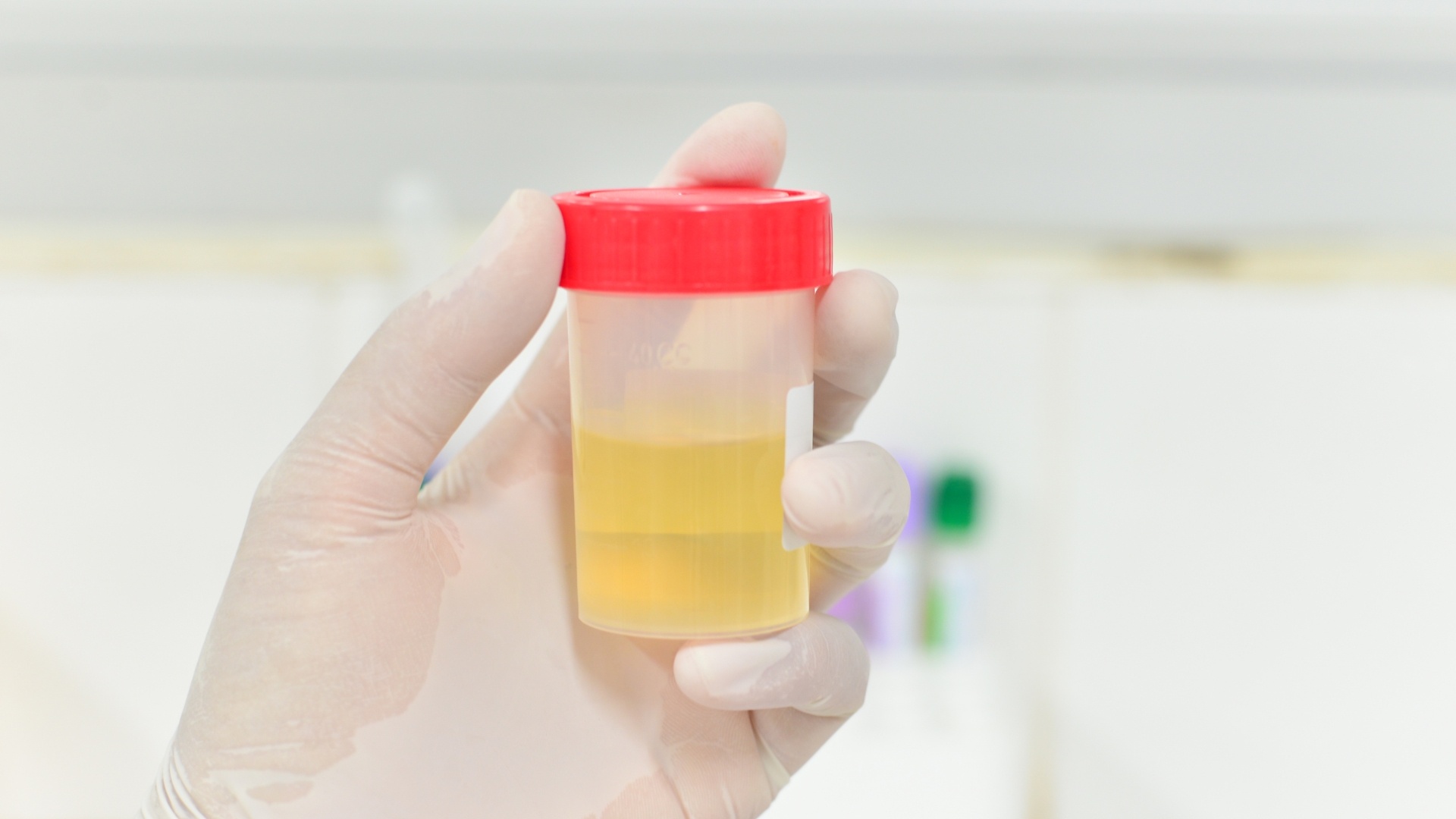 Xét nghiệm albumin niệu hoặc tỉ lệ albumin/creatinin niệu thường dùng để sàng lọc và theo dõi bệnh thận mạn