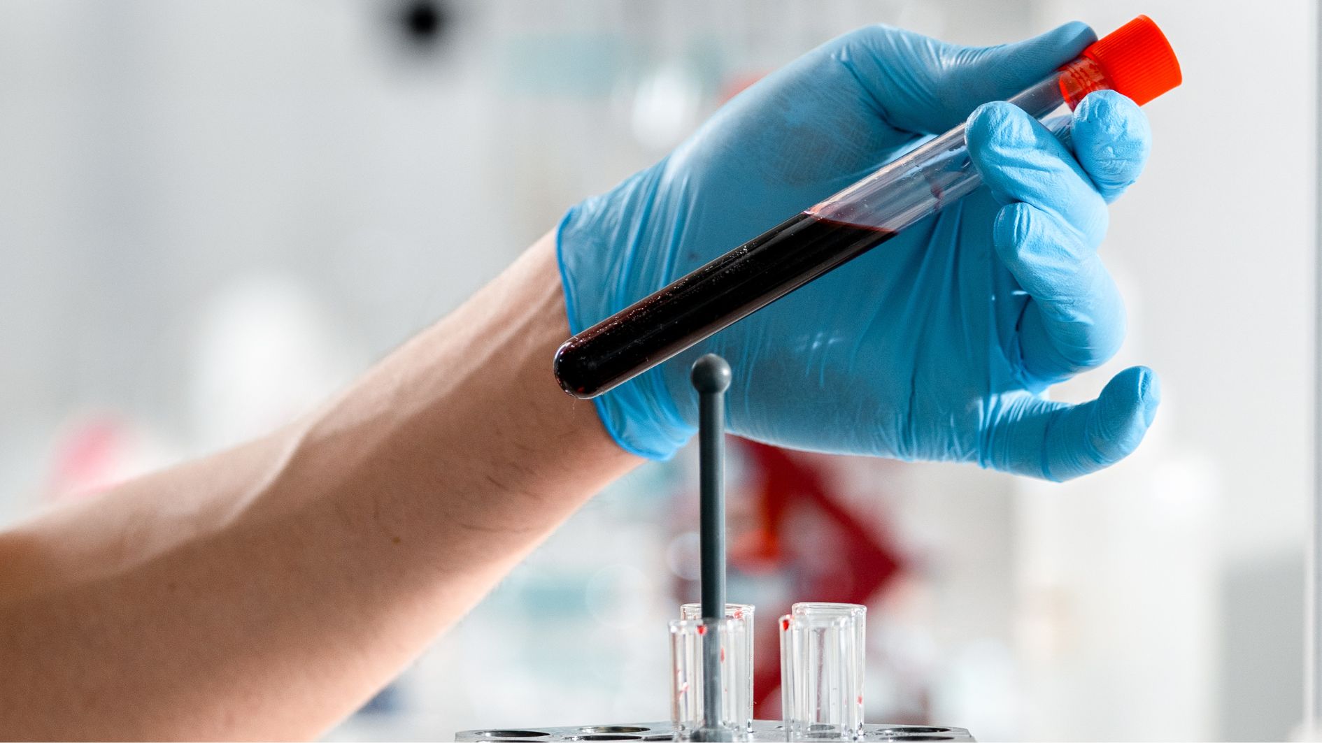 Xét nghiệm CRP thường được chỉ định nhằm theo dõi hiệu quả điều trị ung thư