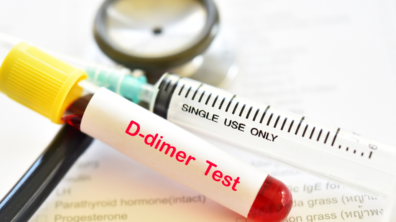 Xét nghiệm D-Dimer trong sàng lọc ban đầu