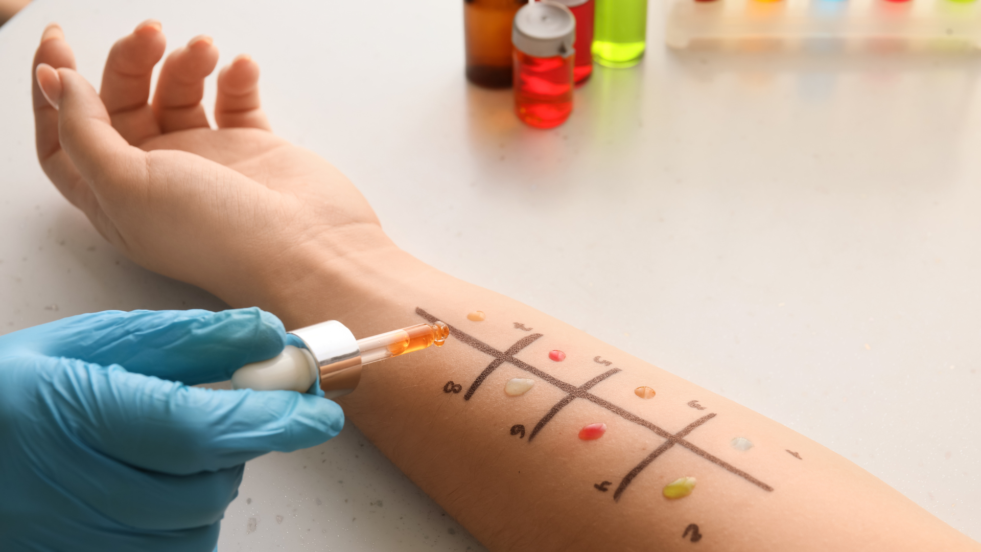 Test lẩy da giúp phát hiện dị nguyên thông qua phản ứng xuất hiện trên bề mặt da