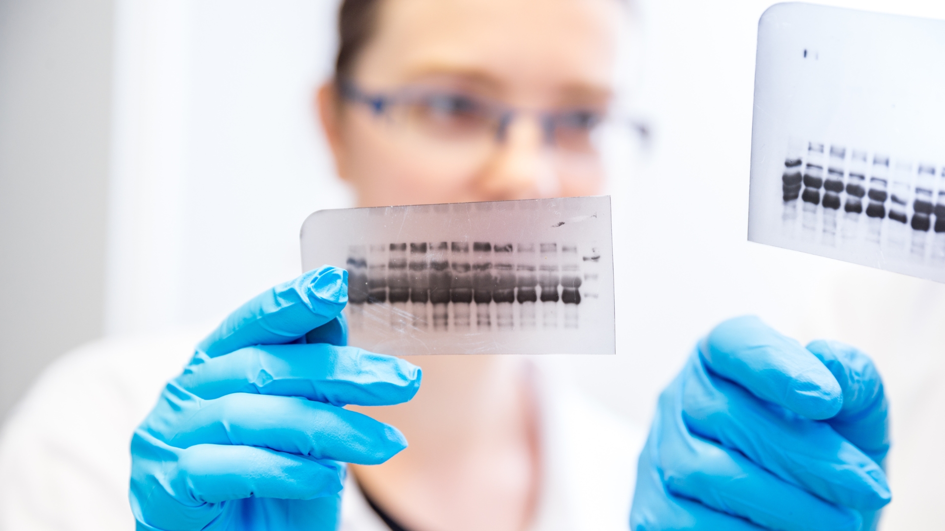 Tỷ lệ gamma globulin đa dòng tăng thường gặp trong bệnh tự miễn hoặc nhiễm trùng kéo dài