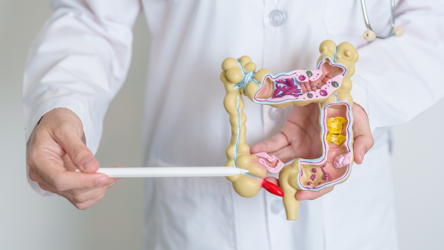 Một số trường hợp ung thư đại trực tràng có thể biểu hiện sự gia tăng CA 72-4 trong huyết thanh