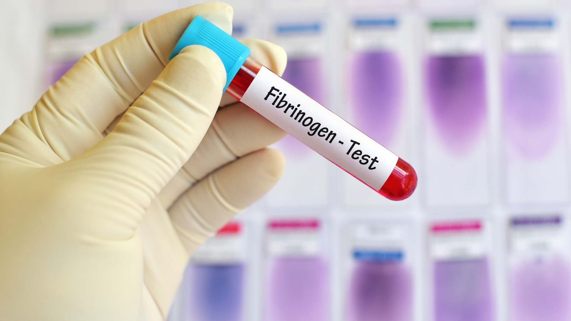 Xét nghiệm fibrinogen giúp bác sĩ đánh giá và xác định nguyên nhân đông máu, tình trạng chảy máu hoặc tắc mạch