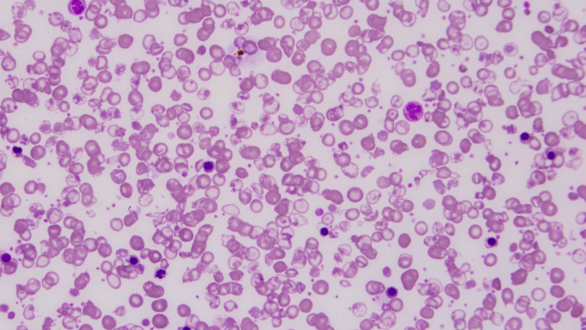 Thalassemia là bệnh di truyền lặn trên nhiễm sắc thể thường, đặc trưng bởi rối loạn tổng hợp hemoglobin