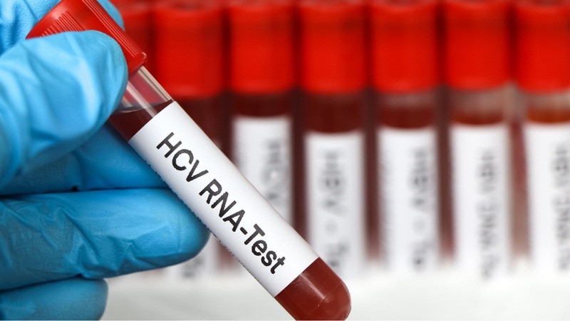 Xét nghiệm HCV RNA nhằm xác định bệnh viêm gan C