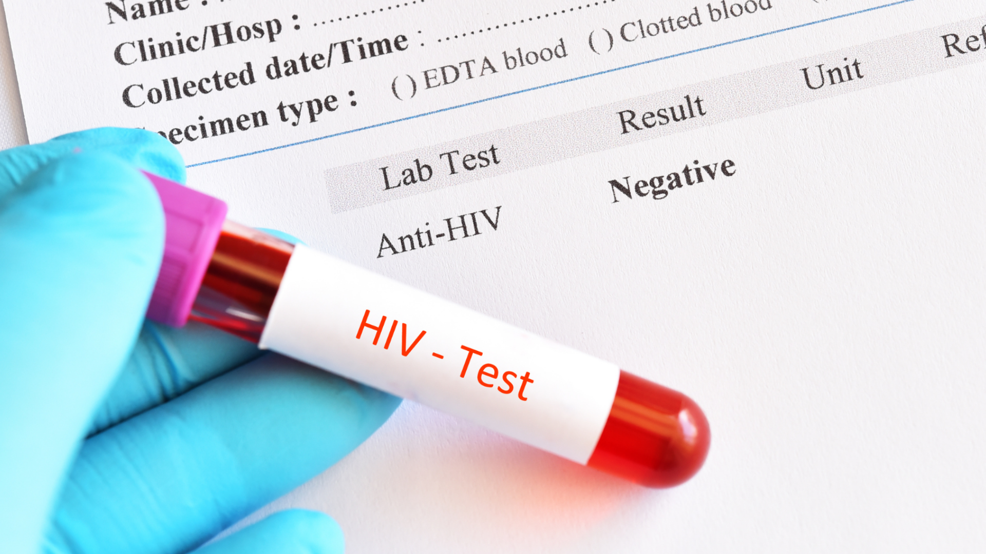 Kết quả xét nghiệm HIV sau 1 năm có chính xác không?