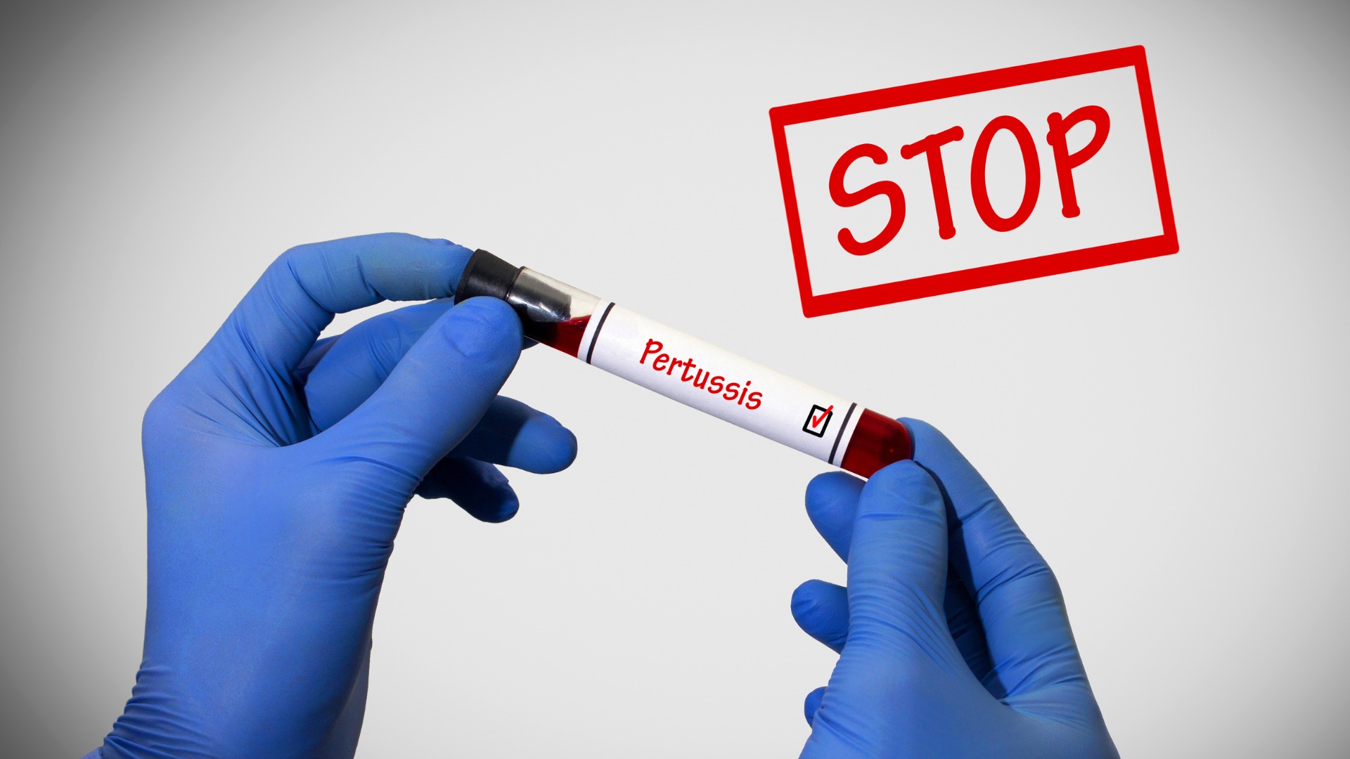 Xét nghiệm ho gà giúp chẩn đoán chính xác nguyên nhân gây bệnh