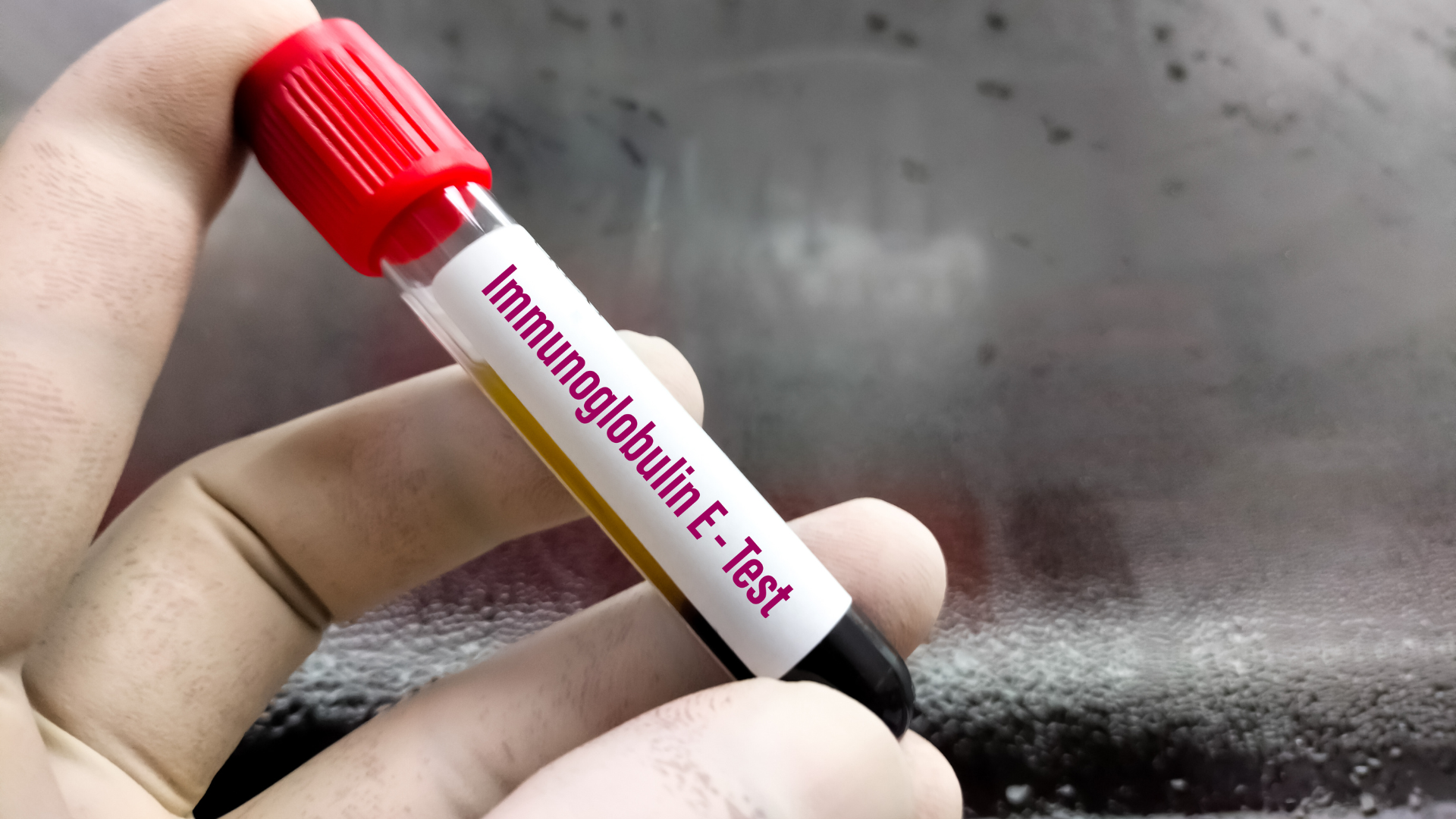 Xét nghiệm IgE là công cụ hỗ trợ quan trọng trong đánh giá dị ứng và một số rối loạn miễn dịch