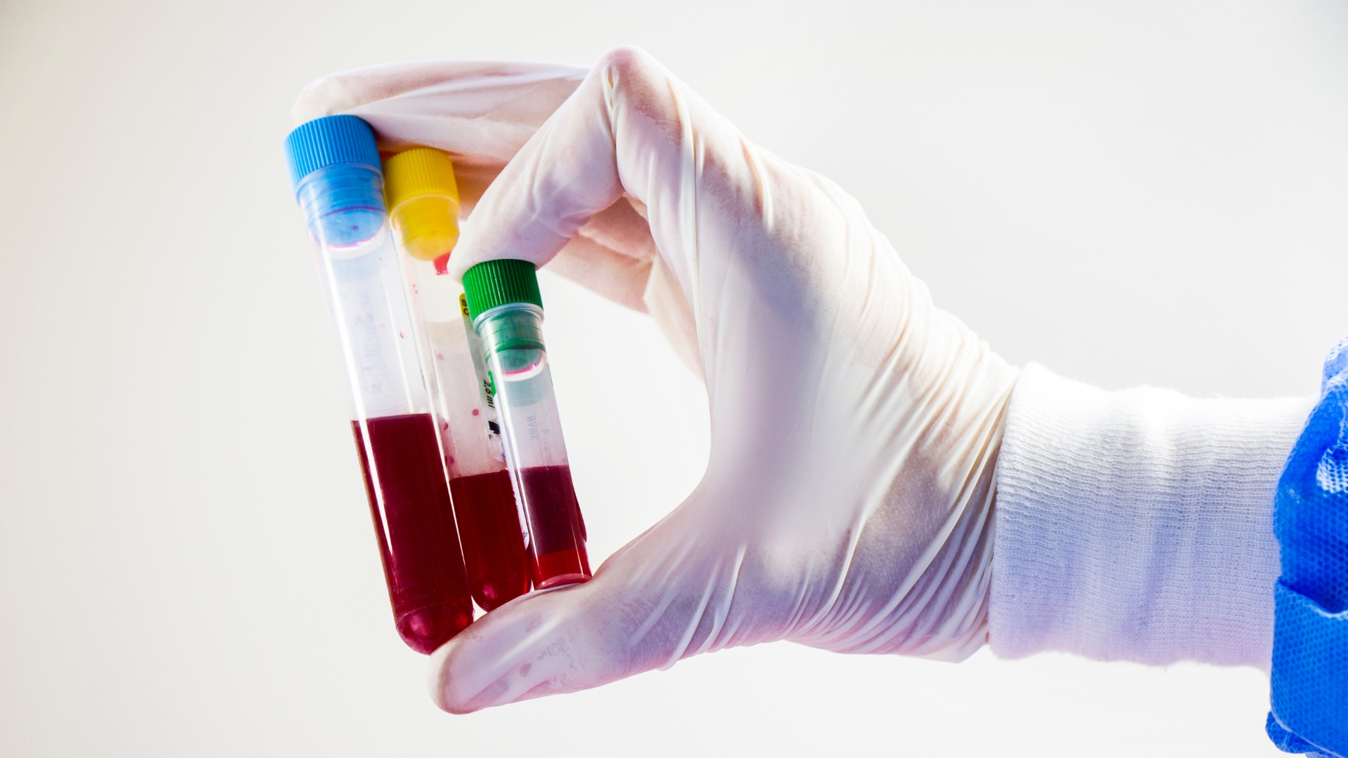 Xét nghiệm lactate thường không yêu cầu nhịn ăn trước khi thực hiện