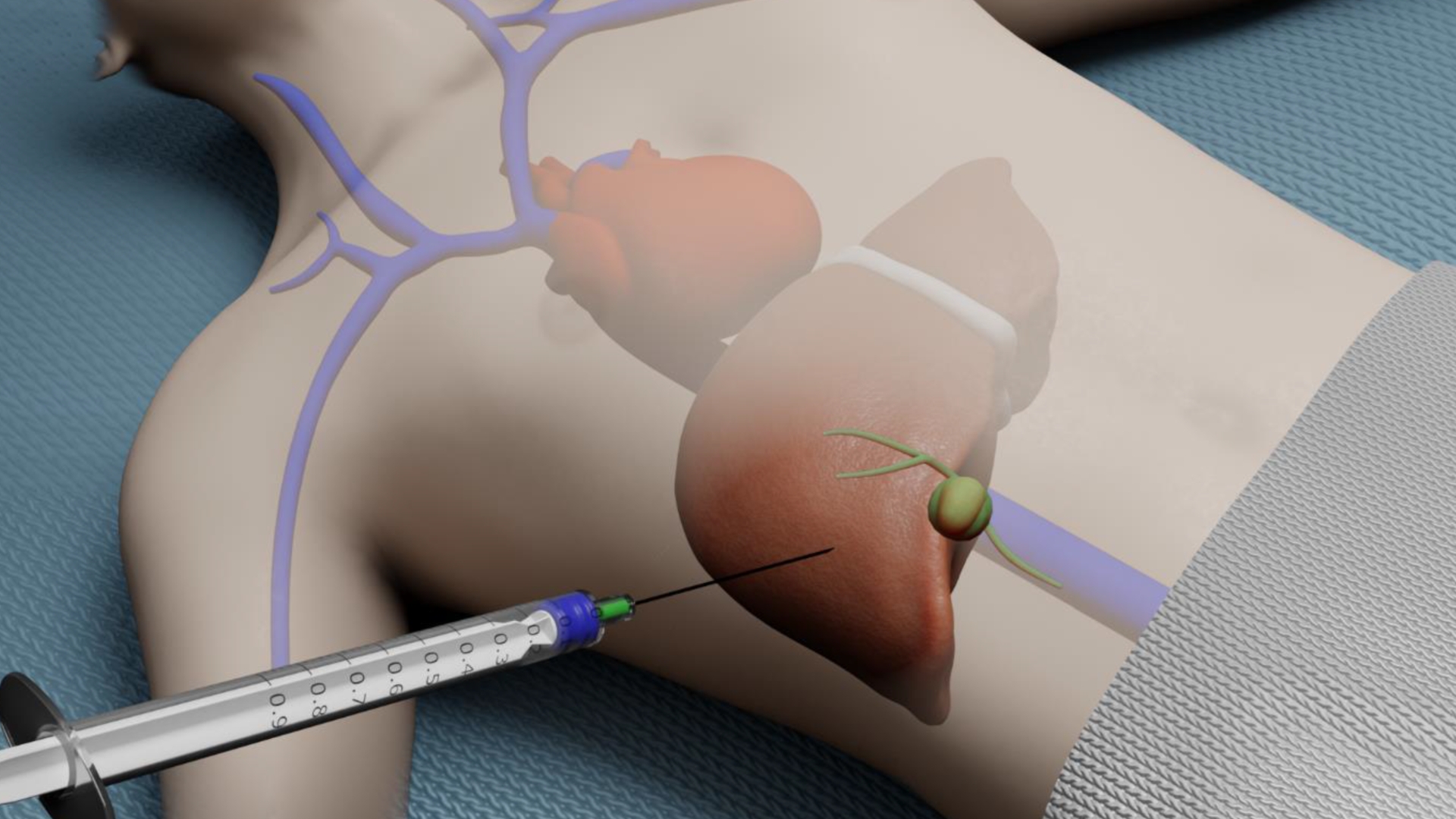 Sinh thiết là phương pháp lấy mẫu mô gan để quan sát dưới kính hiển vi, giúp xác định chính xác có tế bào ung thư hay không