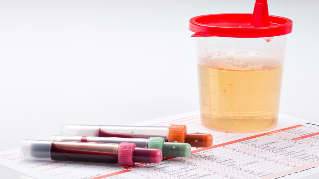 Ý nghĩa của xét nghiệm máu và nước tiểu trong khám sức khỏe