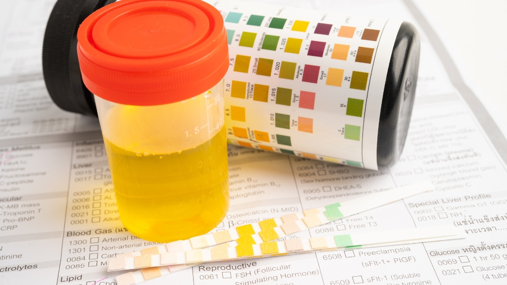 Các chỉ số quan trọng cần biết trong xét nghiệm nước tiểu