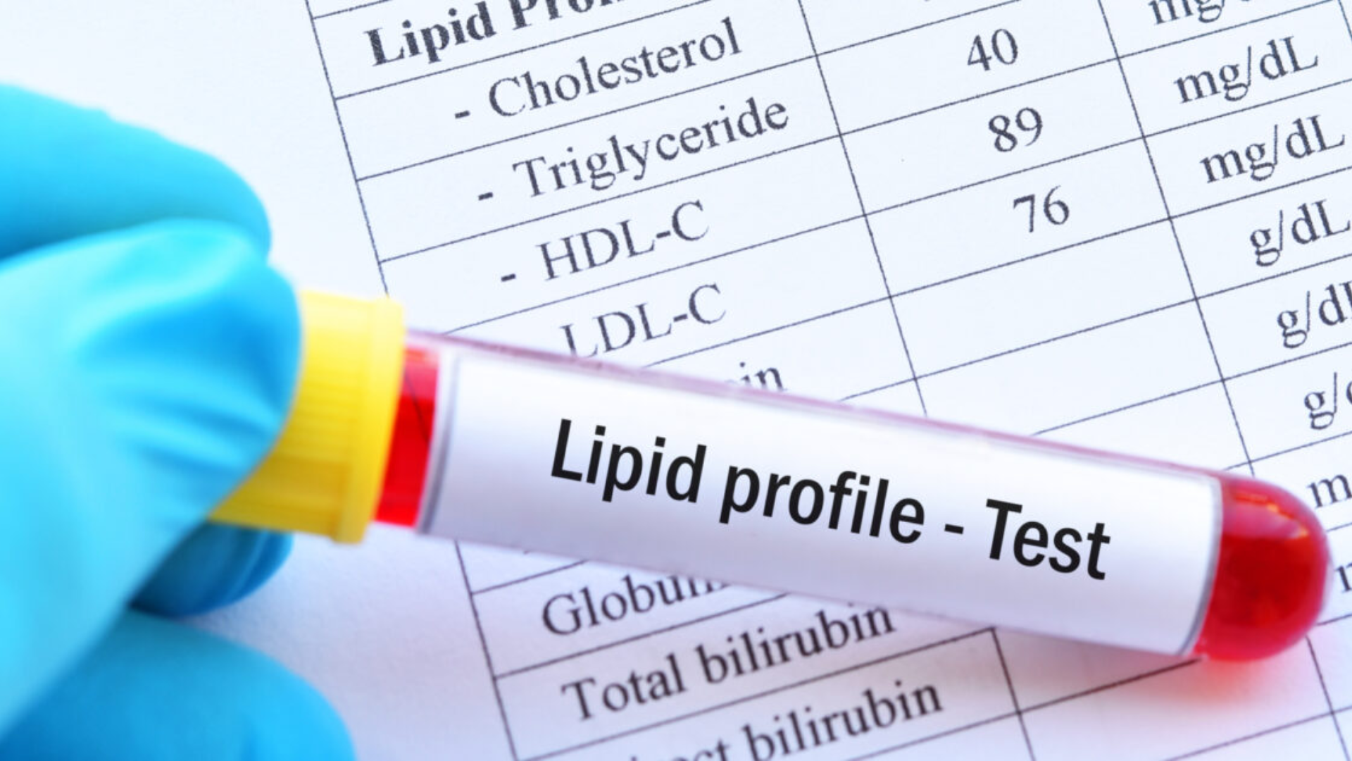 Gói xét nghiệm mỡ máu cơ bản thường có giá dao động từ 100.000 đến 200.000 đồng