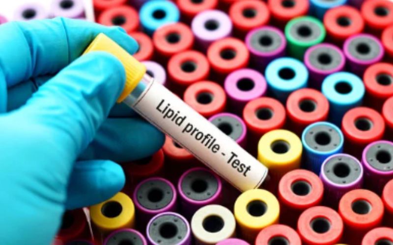 Xét nghiệm mỡ máu nên được thực hiện vào buổi sáng sớm