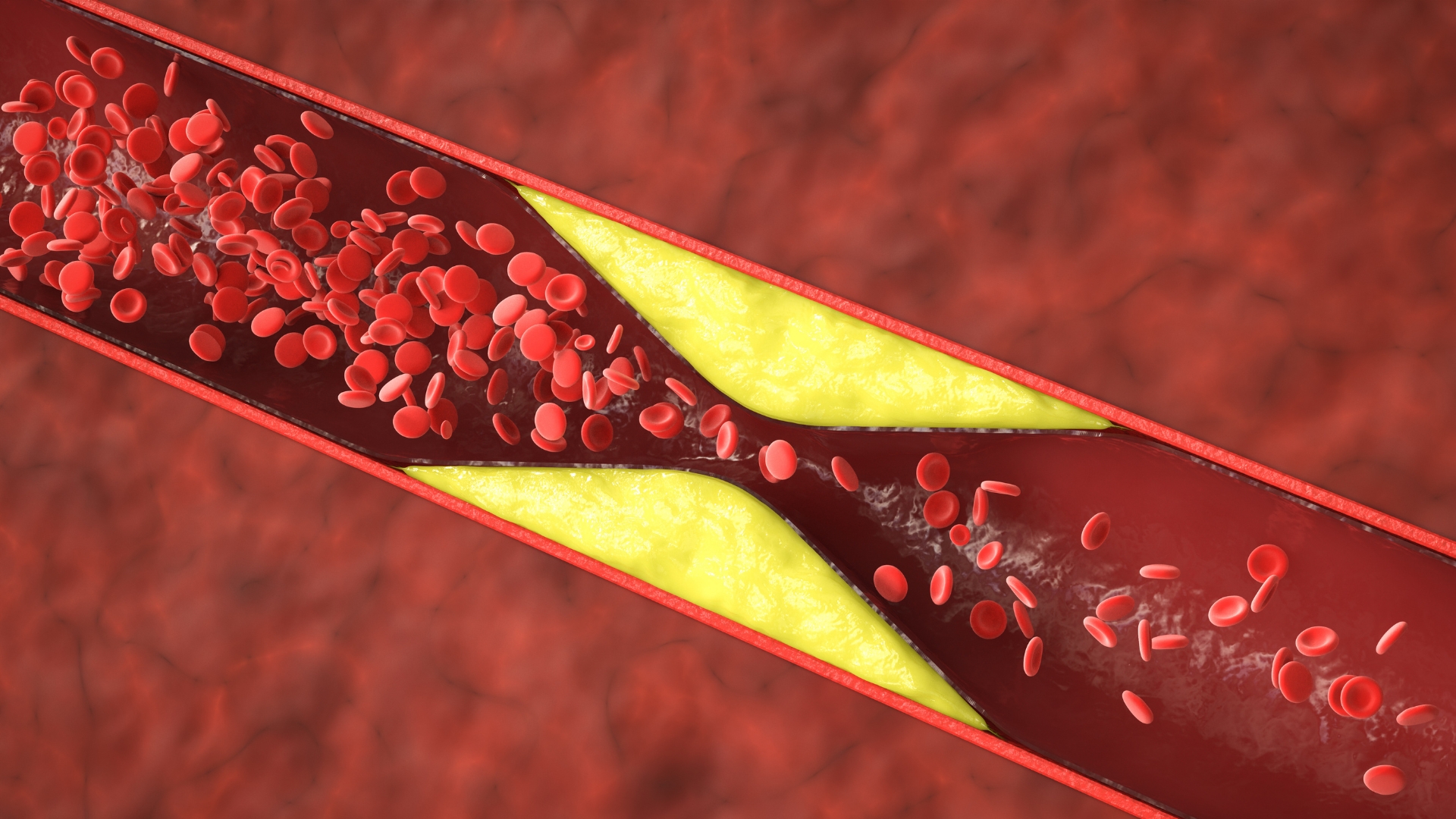 MPO có thể góp phần vào quá trình oxy hóa LDL và tổn thương nội mô, từ đó thúc đẩy hình thành và mất ổn định mảng xơ vữa