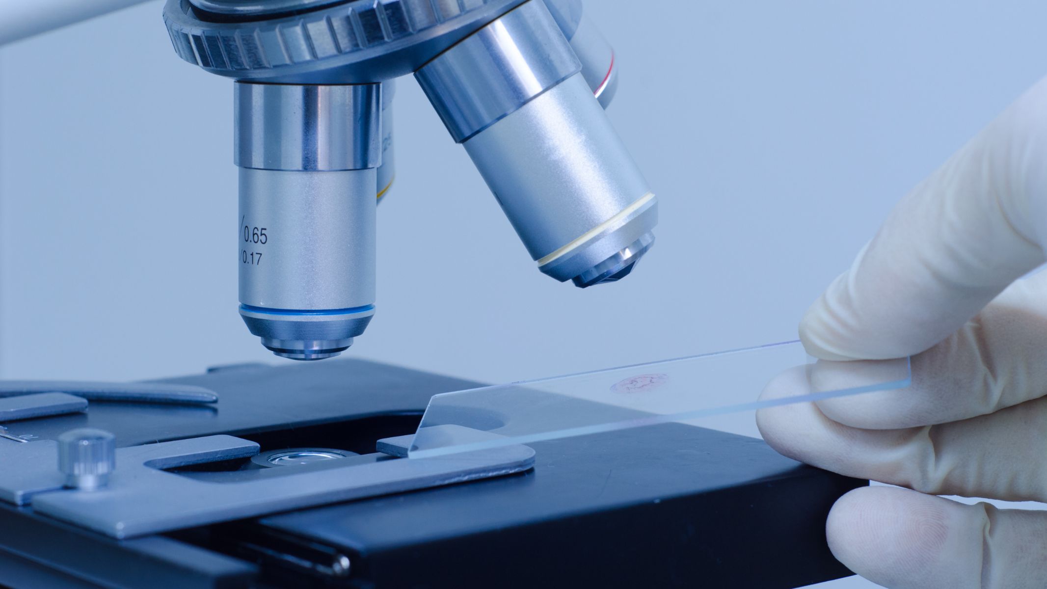 Kỹ thuật nhuộm Gram là xét nghiệm nấm Candida giúp quan sát rõ hơn hình thái và mật độ nấm trong mẫu bệnh phẩm