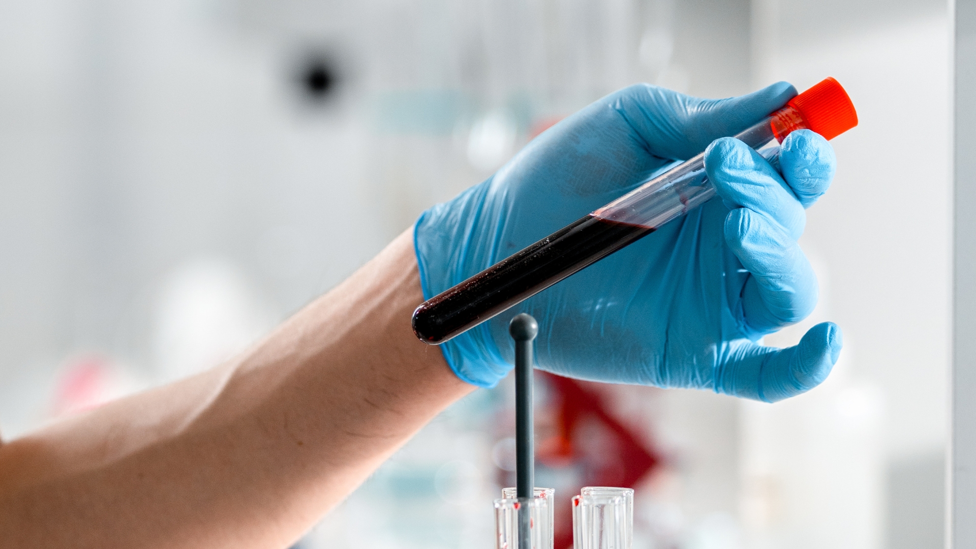 Xét nghiệm NAT HIV bao nhiêu tiền phụ thuộc vào nhiều yếu tố