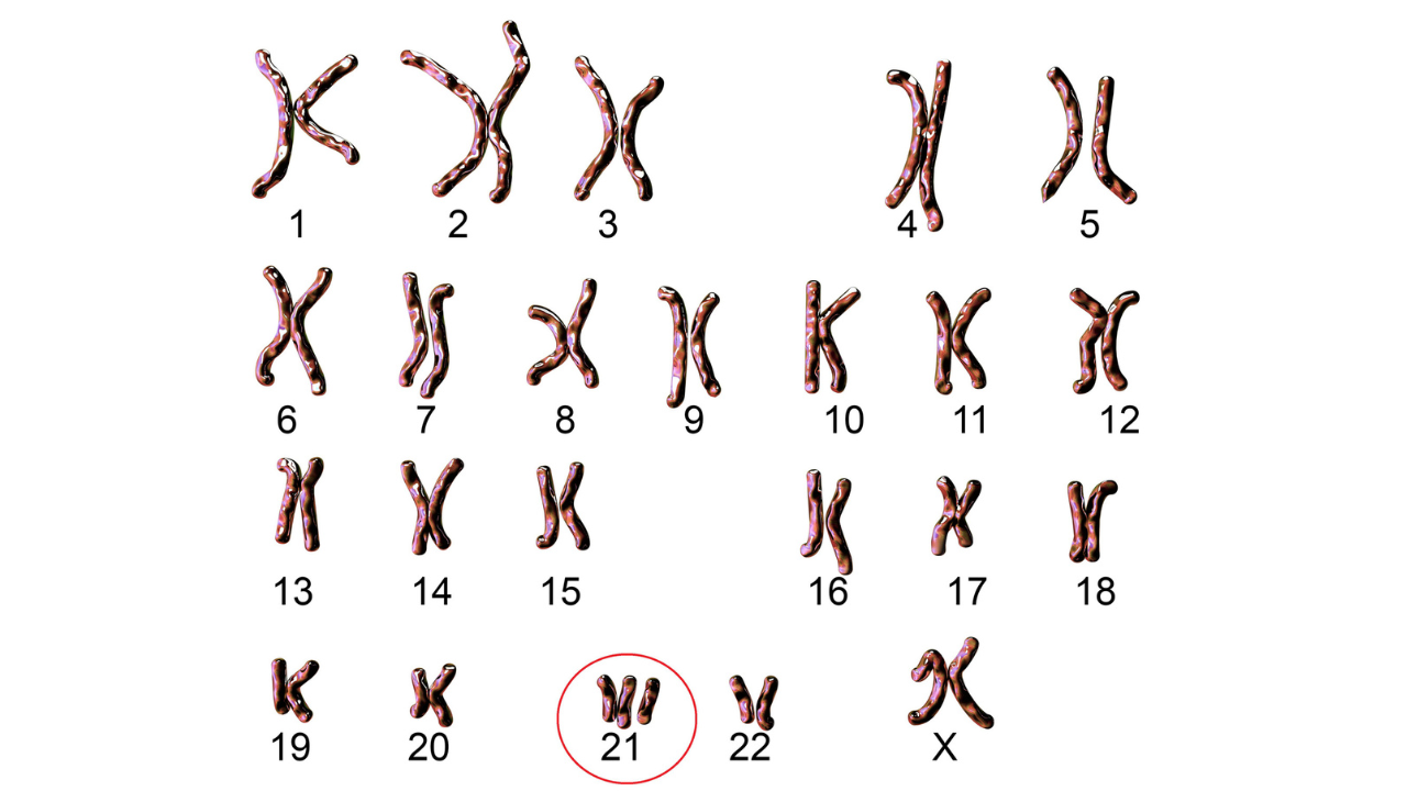 Khi gặp tình trạng dư một NST số 21 được gọi là hội chứng Down