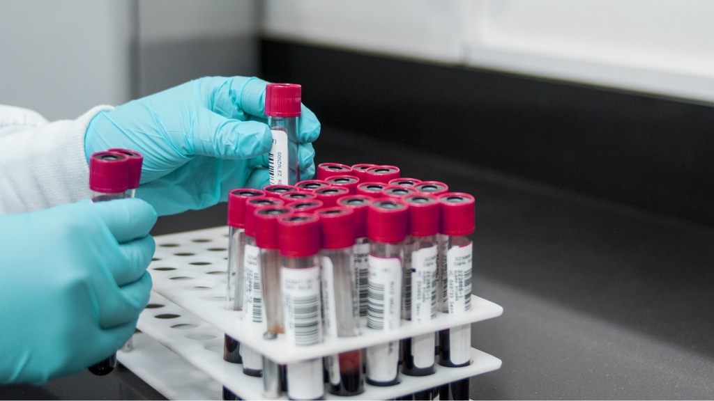 Xét nghiệm nhồi máu cơ tim: Các phương pháp chẩn đoán chính xác và cần thiết 2