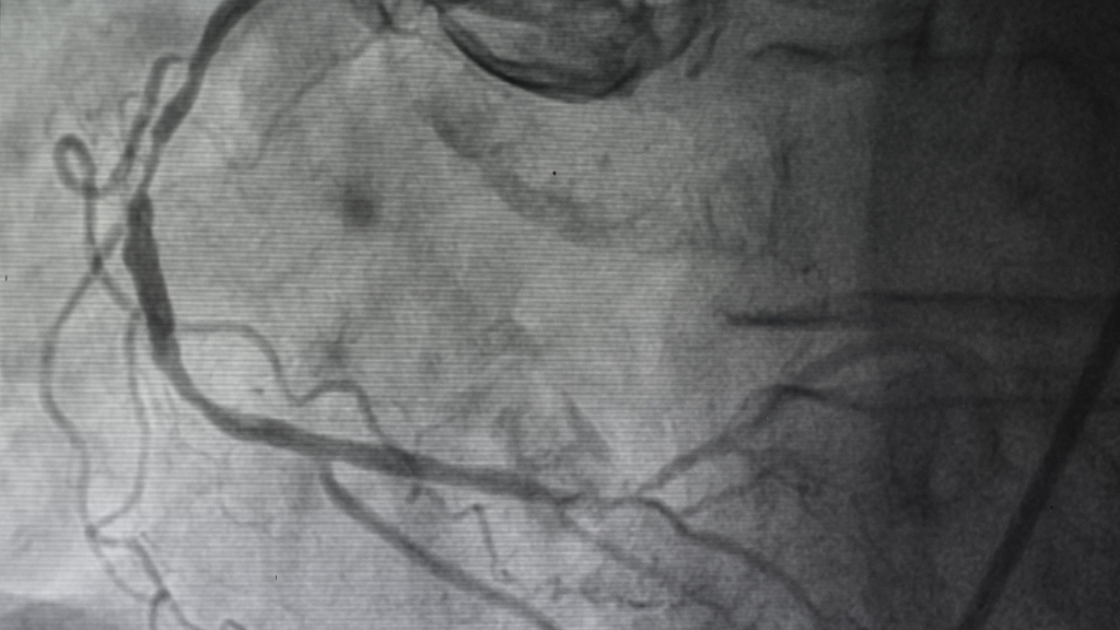 Xét nghiệm nhồi máu cơ tim: Các phương pháp chẩn đoán chính xác và cần thiết 3