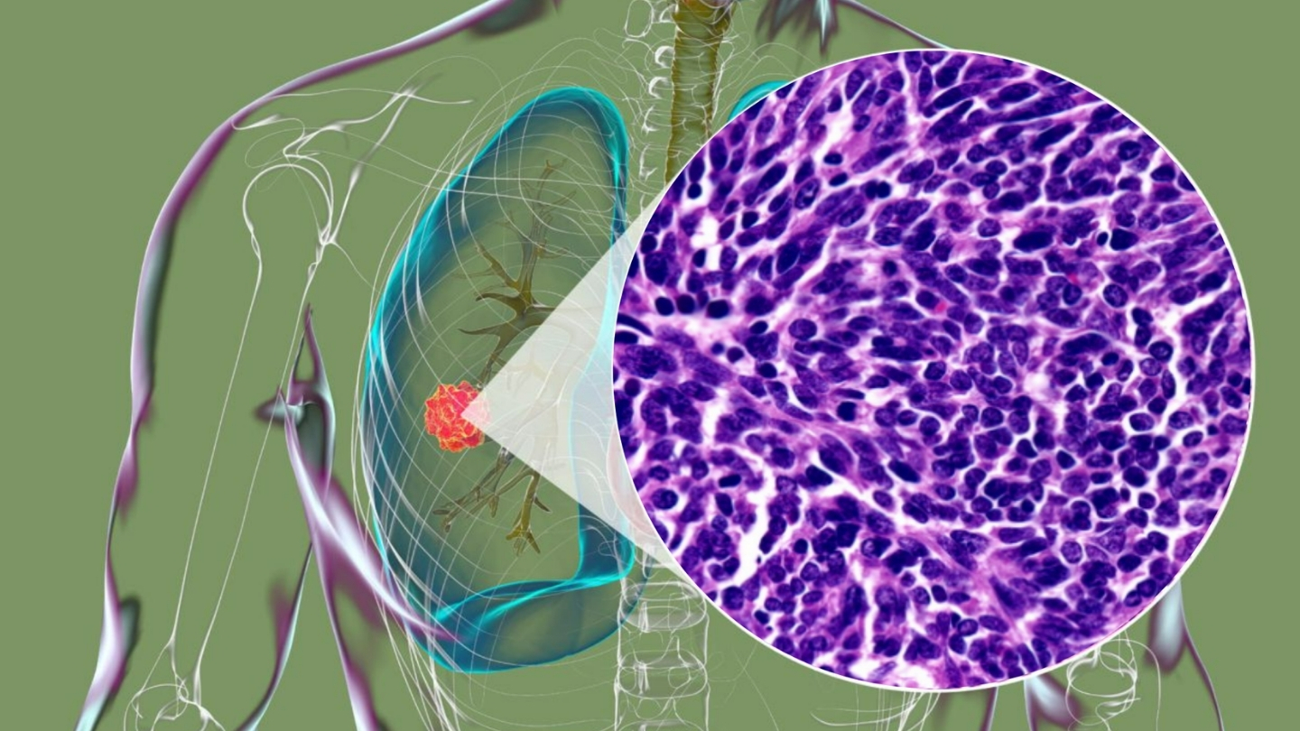 Xét nghiệm định lượng NSE có thể được chỉ định khi nghi ngờ bệnh nhân mắc ung thư phổi tế bào nhỏ