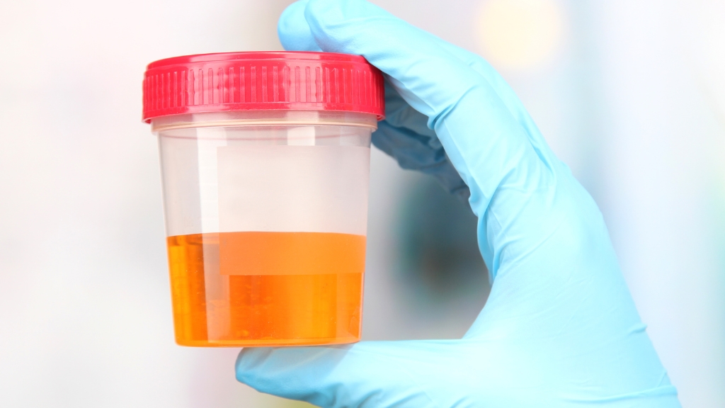 Xét nghiệm nước tiểu có phát hiện HIV không và câu trả lời chính xác