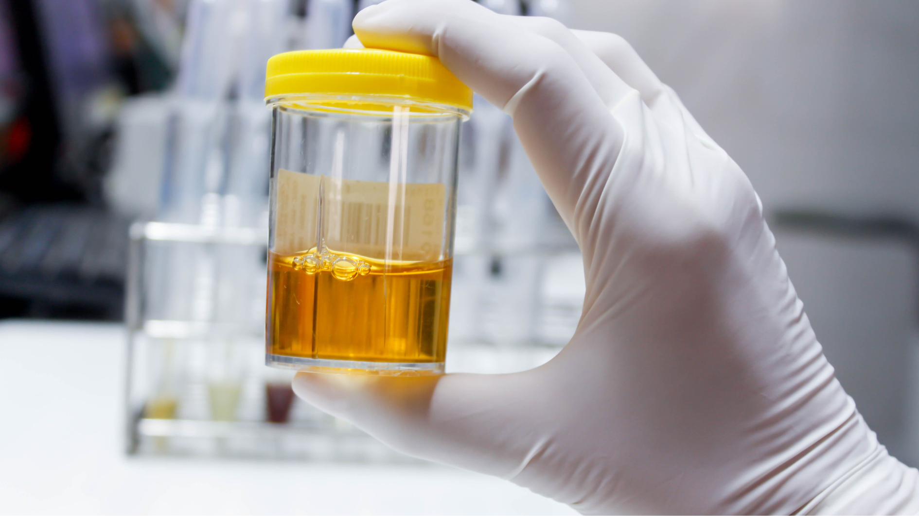 Xét nghiệm nước tiểu khi mang thai là gì? Có ý nghĩa gì? 3