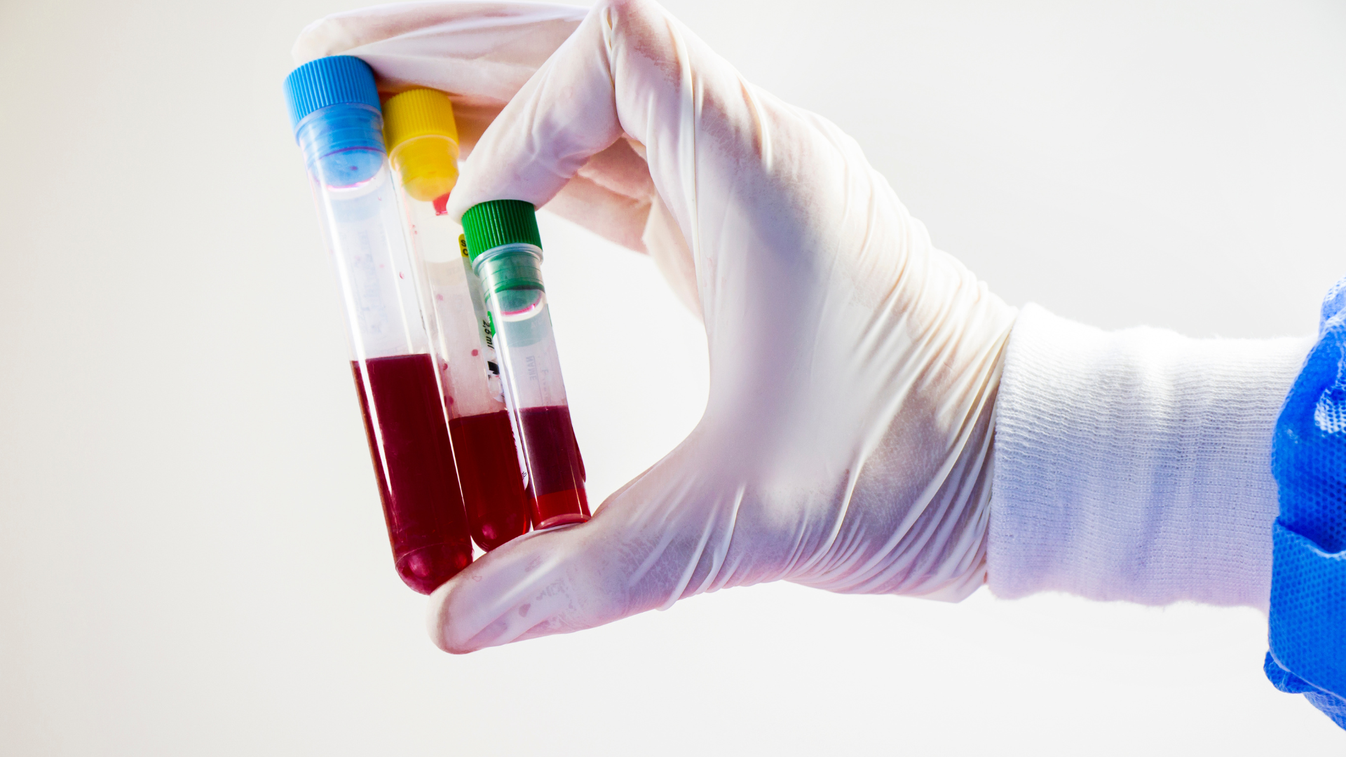 Xét nghiệm proBNP là công cụ quan trọng giúp phát hiện sớm suy tim