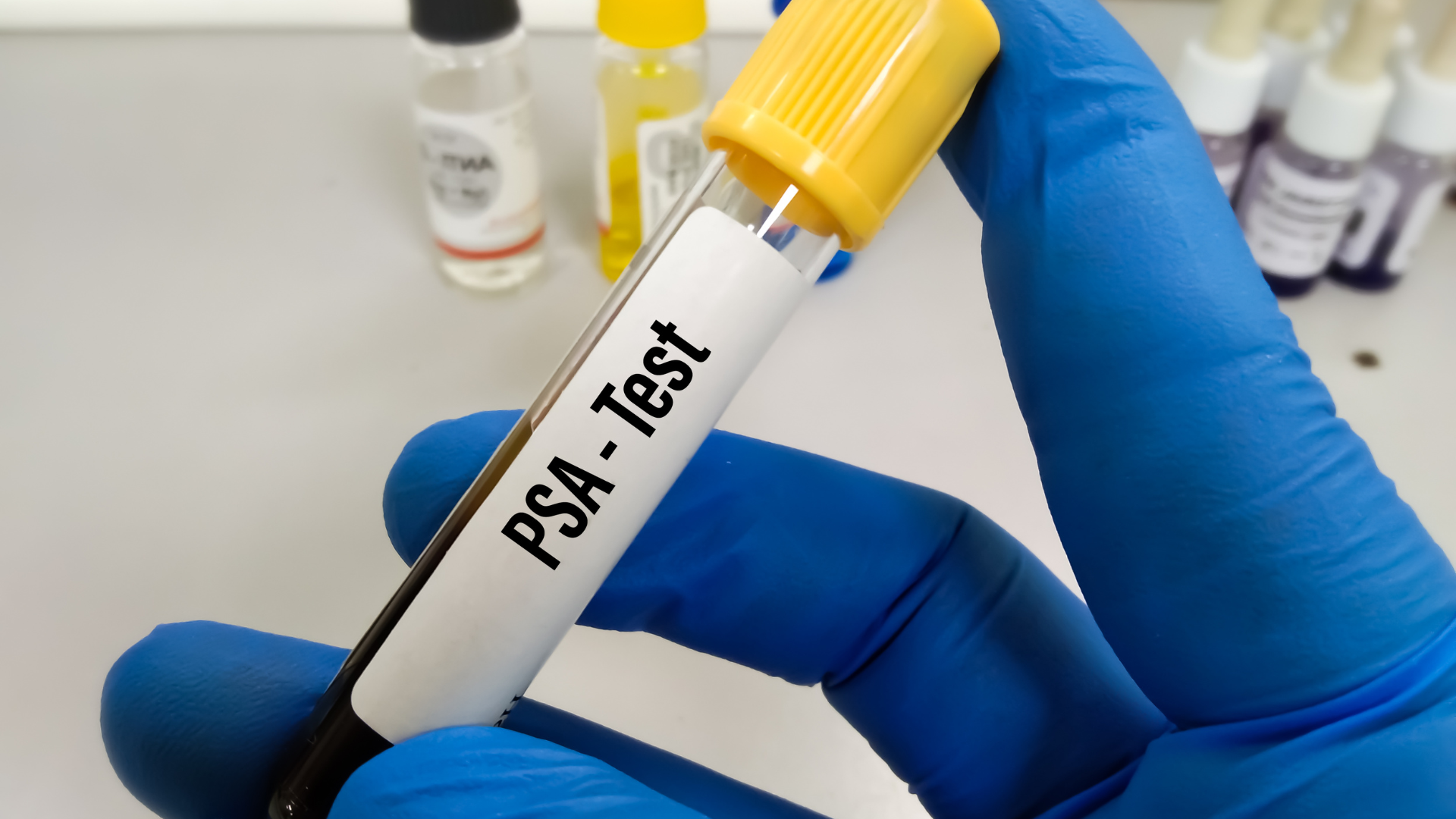 Xét nghiệm PSA bao nhiêu tiền là nỗi băn khoăn của nhiều người bệnh