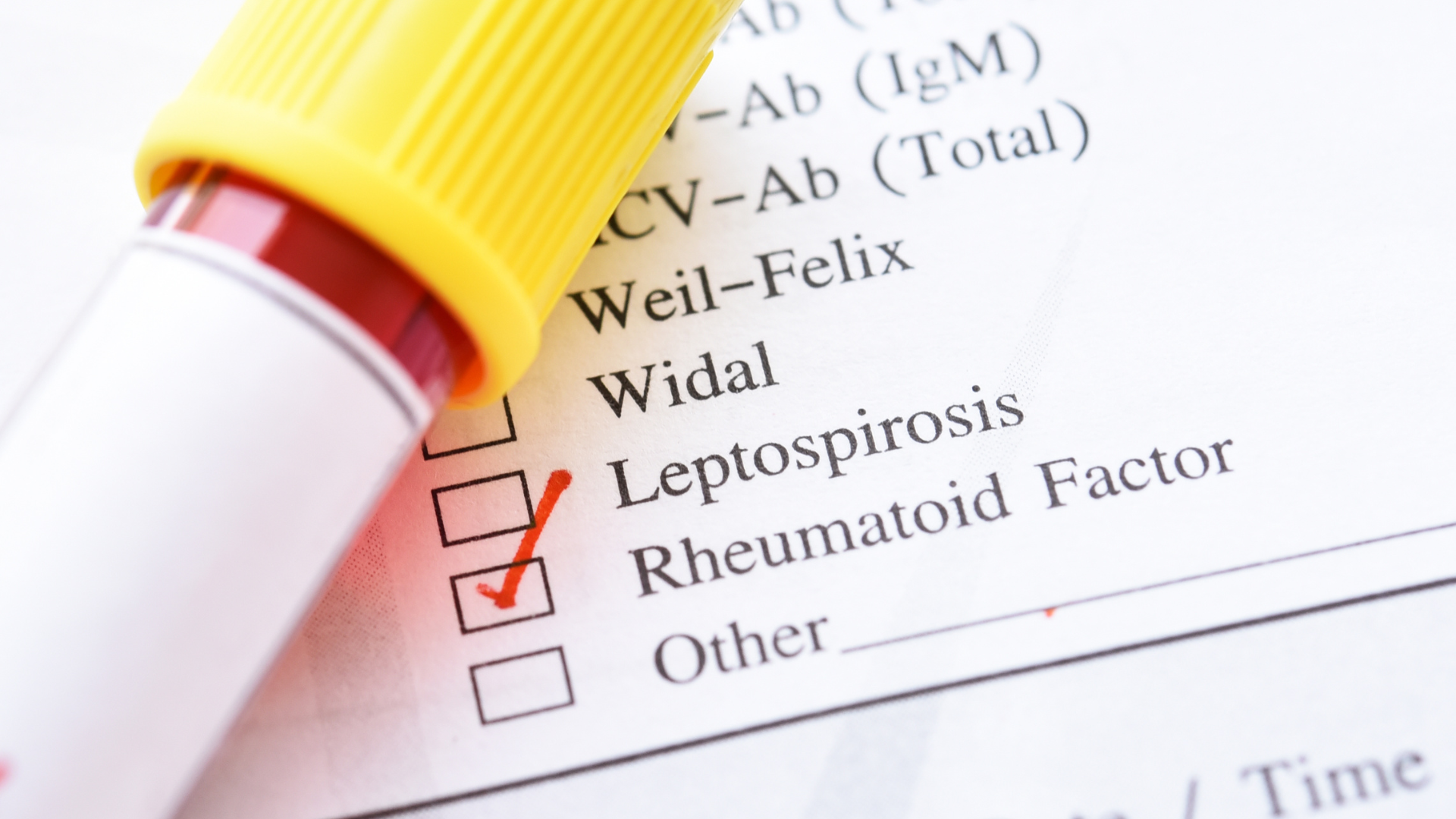 Xét nghiệm RF là xét nghiệm máu nhằm đo nồng độ yếu tố dạng thấp trong huyết thanh