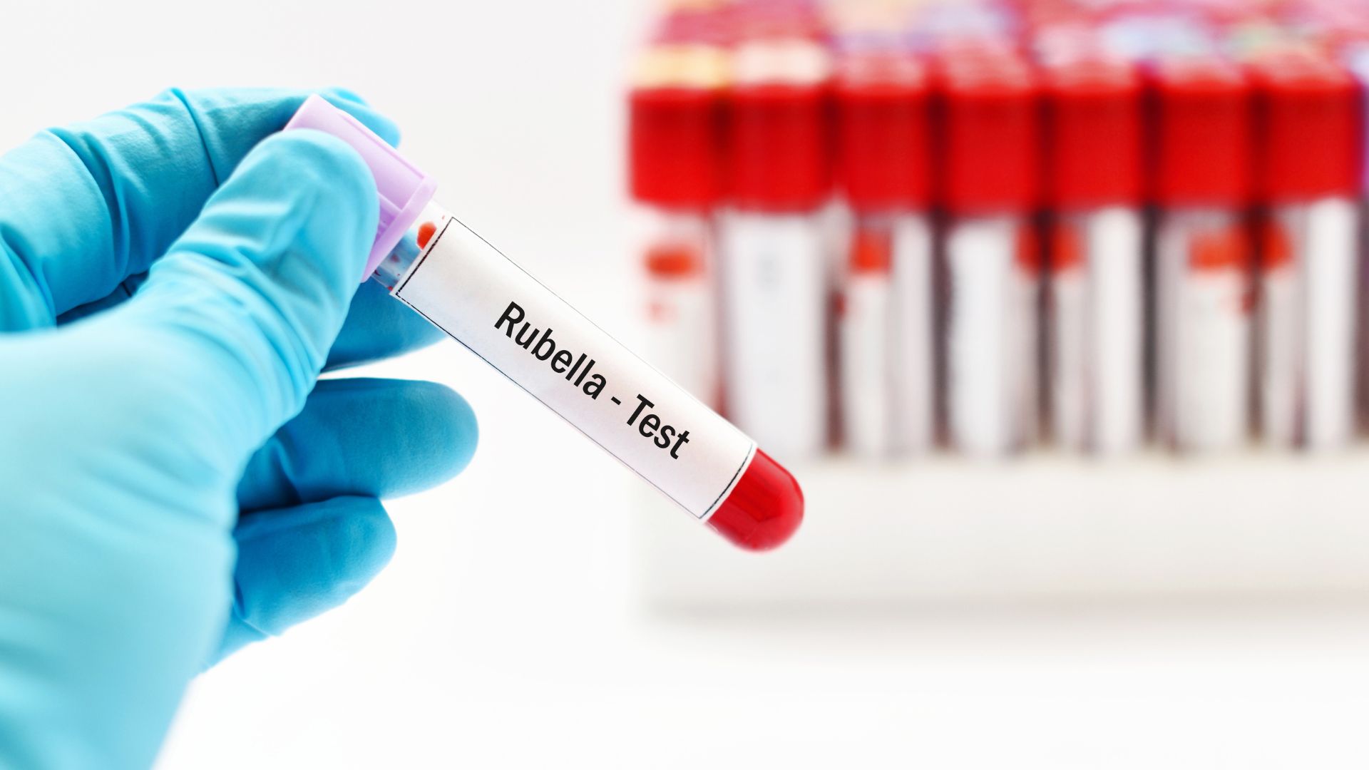 Xét nghiệm rubella giúp bác sĩ đánh giá nguy cơ và đưa ra các biện pháp can thiệp kịp thời