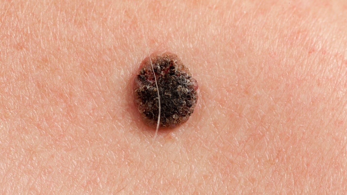 SCC là chỉ điểm khối u đặc hiệu cho các ung thư biểu mô tế bào vảy