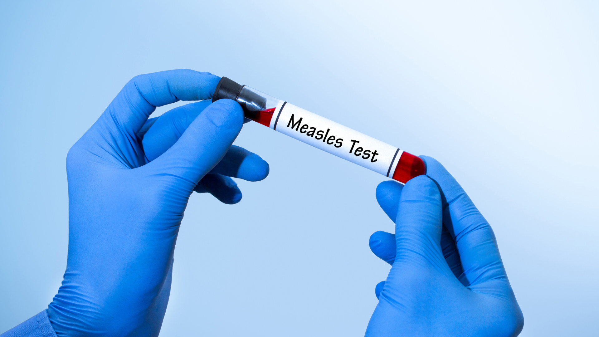 Xét nghiệm Measles IgM có độ tin cậy cao trong chẩn đoán bệnh sởi