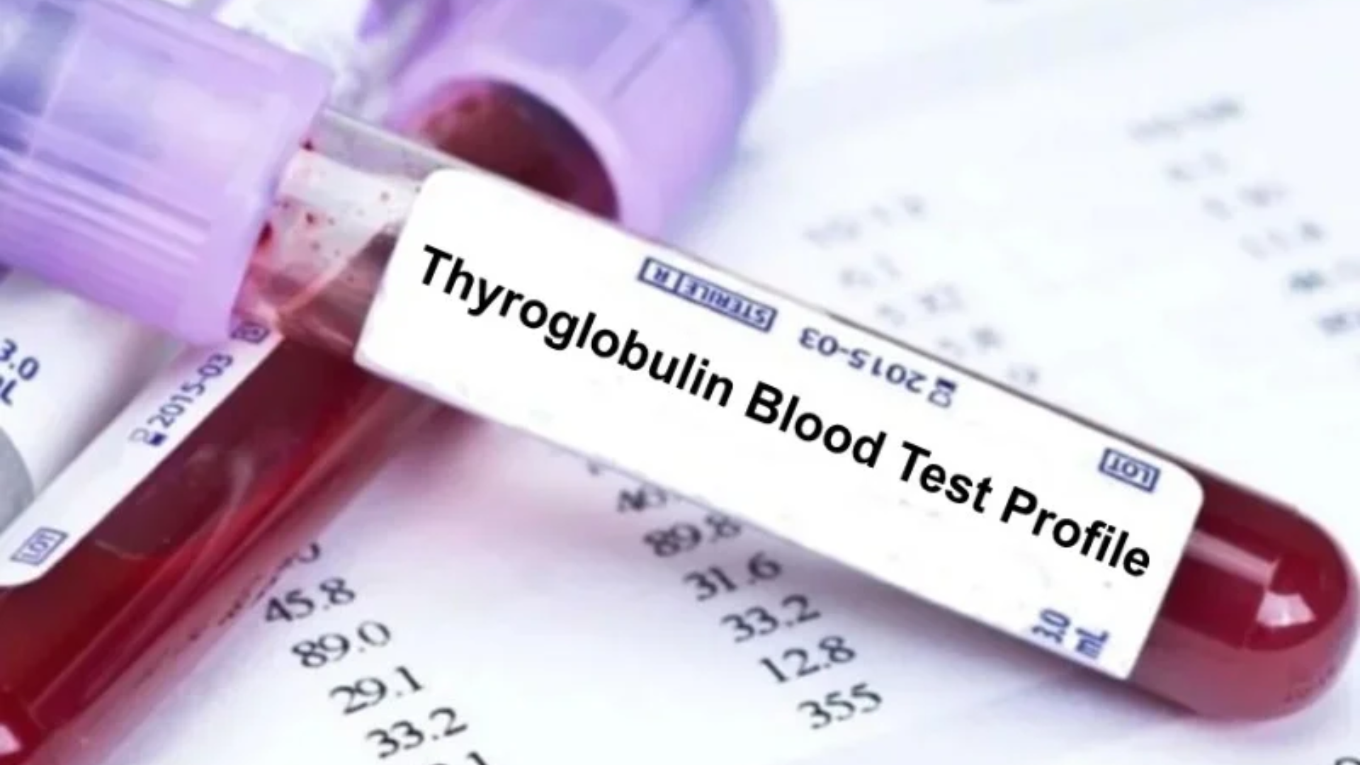 Thyroglobulin là chỉ dấu quan trọng trong theo dõi ung thư tuyến giáp sau phẫu thuật và xạ trị