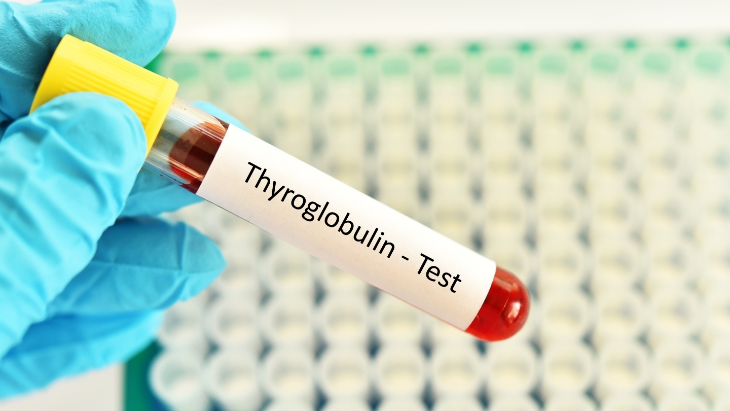 Xét nghiệm TG là xét nghiệm máu dùng để đo nồng độ thyroglobulin trong huyết thanh