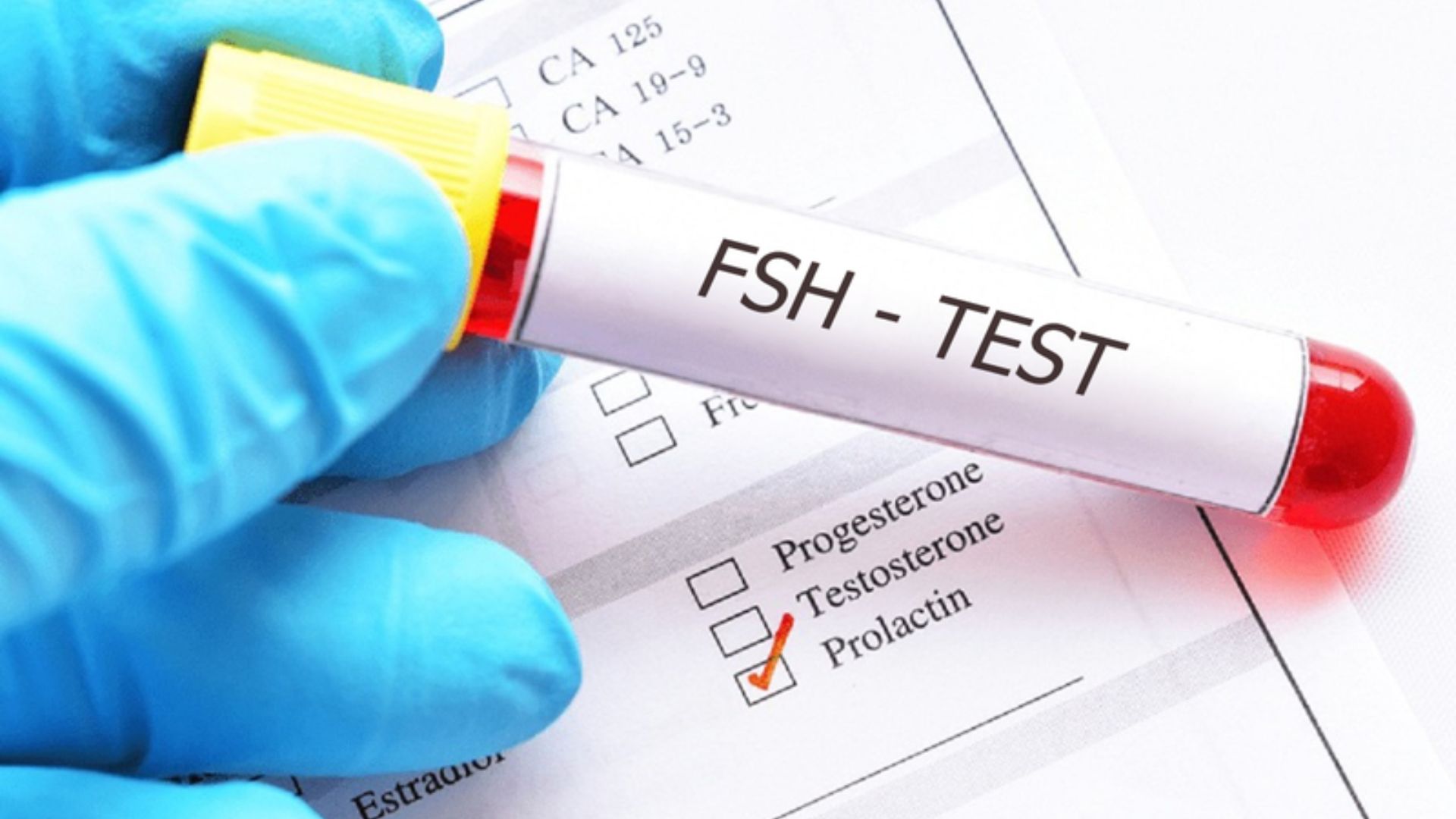 Xét nghiệm FSH là một trong các xét nghiệm hormone sinh dục được chỉ định phổ biến