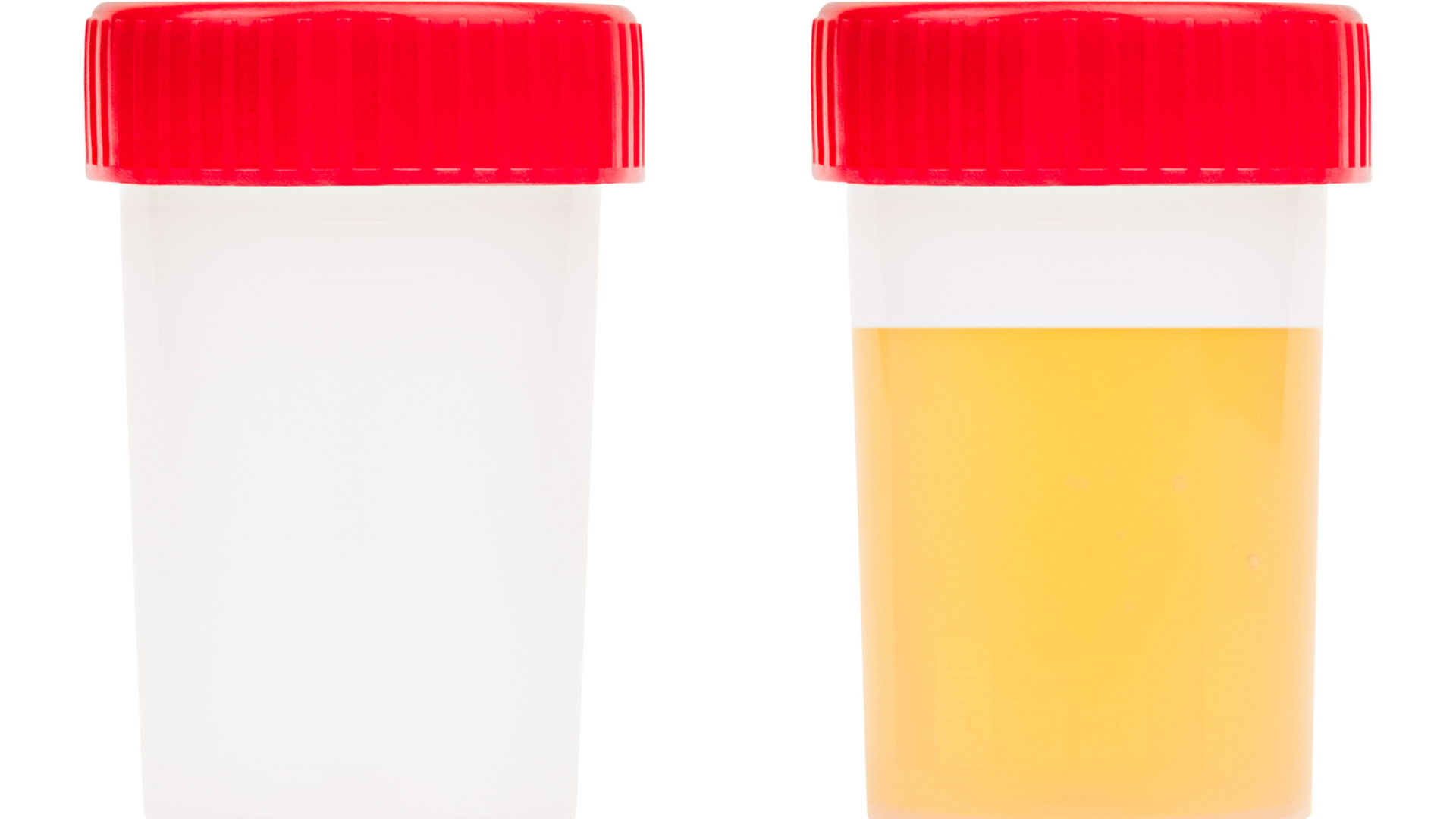 Nếu lấy mẫu nước tiểu sai cách, vi khuẩn từ da hoặc niêm mạc vùng sinh dục có thể lẫn vào mẫu và gây kết quả sai lệch