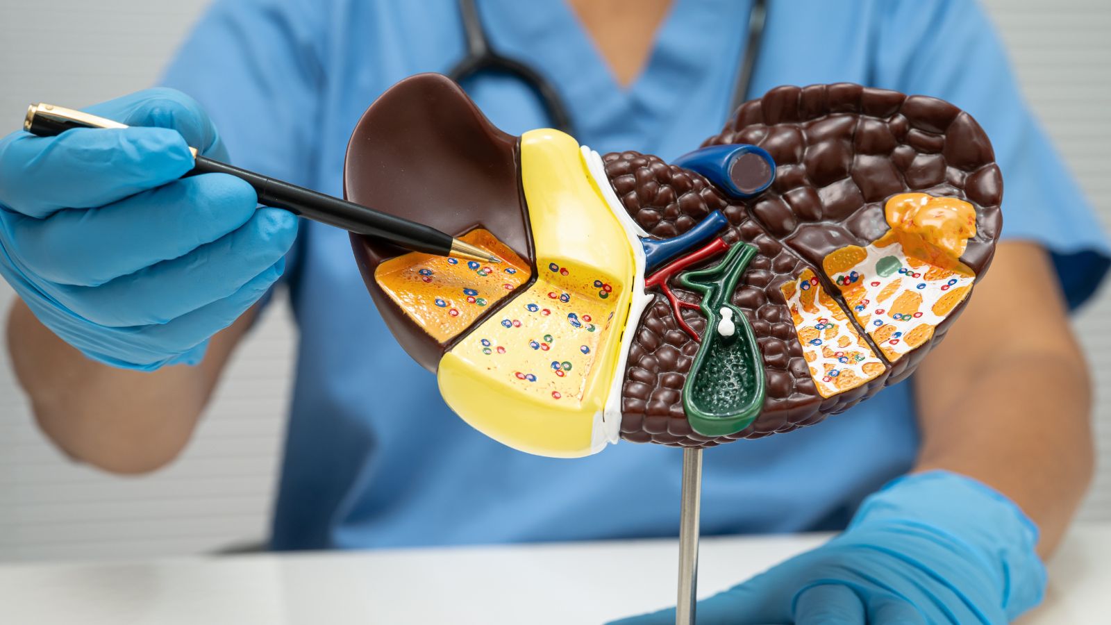 Xơ gan F4 có chữa được không?